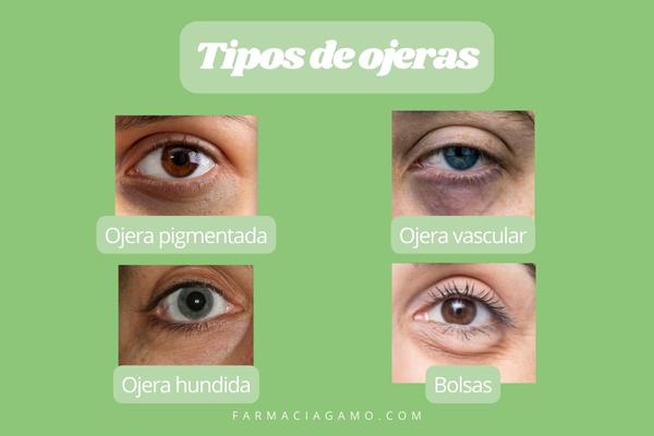 tipo de ojeras según el contorno de tus ojos 